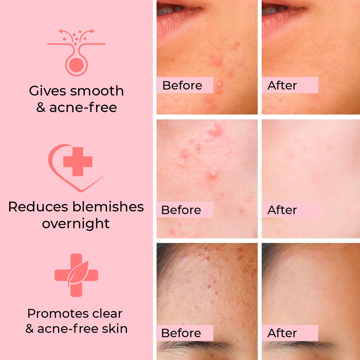 Overnight Acne Relief Hydrocolloid Pimple Patches With Salicylic Acid